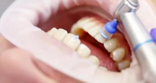 Как выполняется ультразвуковая чистка зубов?